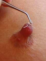 Saline Injection